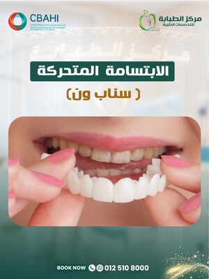 Removable Veneer (Snap-On)