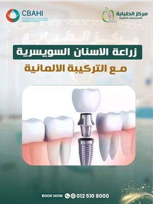 زراعة الاسنان السويسرية مع التركيبة الالمانية ٦٠٠٠ ريال