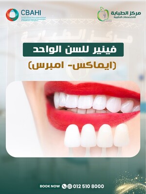 Veneer for a Single Tooth (Emax - Empress)