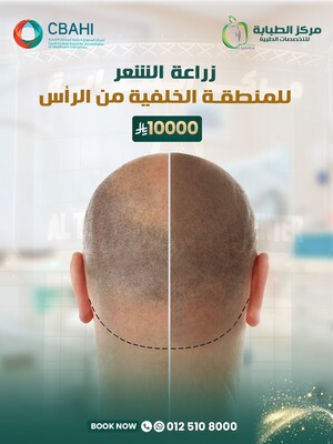 زراعة الشعر للمنطقة الخلفية من الرأس