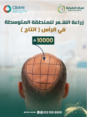 زراعة الشعر للمنطقة المتوسطة في الرأس (التاج)